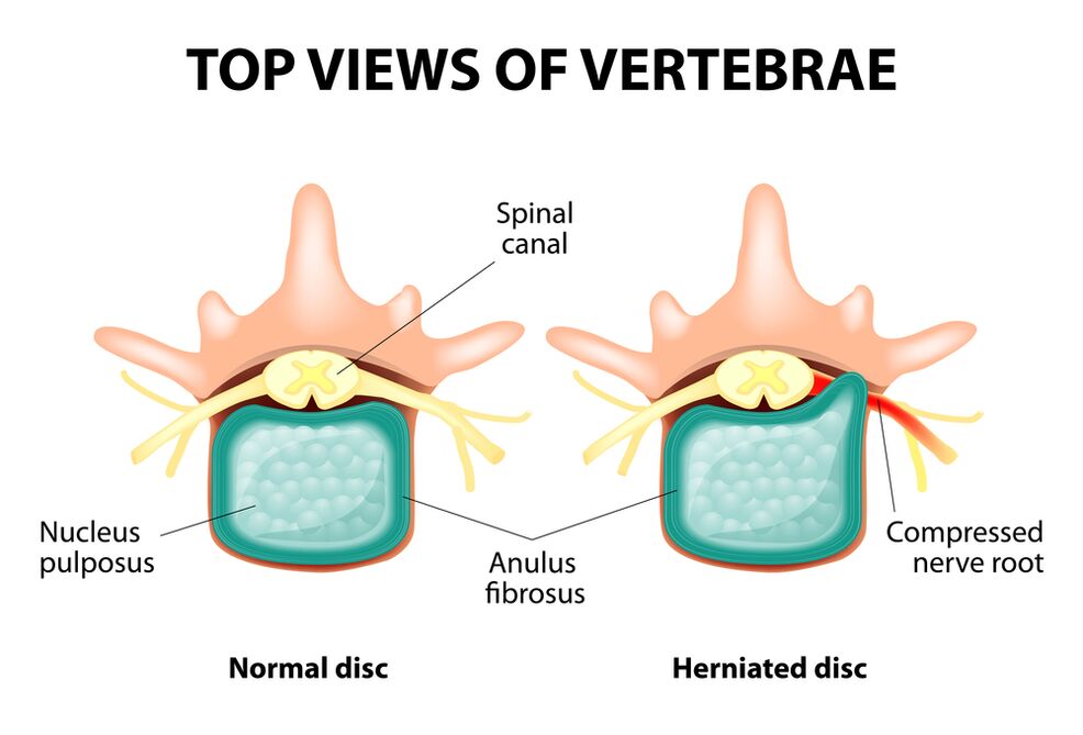 Disco intervertebrale sano ed ernia