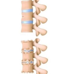 Le cause dell'osteocondosi