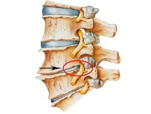 Segni e sintomi di osteocondosi