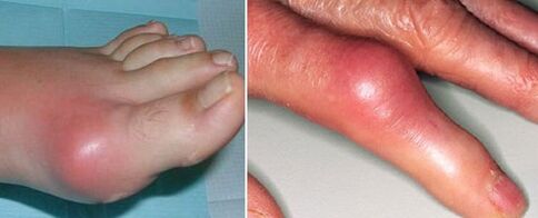 comparsa di articolazioni con artrite