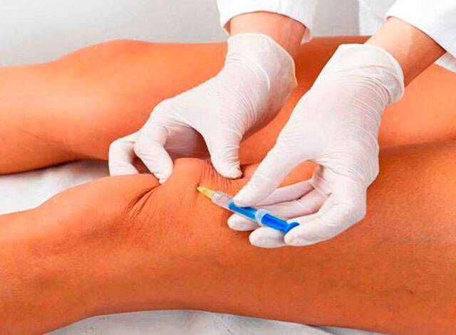Iniezioni intrarticolari di farmaci per l'artrosi dell'articolazione del ginocchio