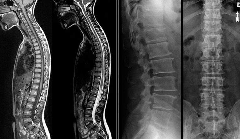 Immagini a raggi X e risonanza magnetica per l'osteocondrosi