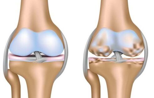 articolazione sana e distruzione dell'articolazione del ginocchio nell'artrosi