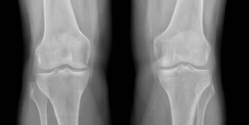 radiografia dell'artrosi del ginocchio
