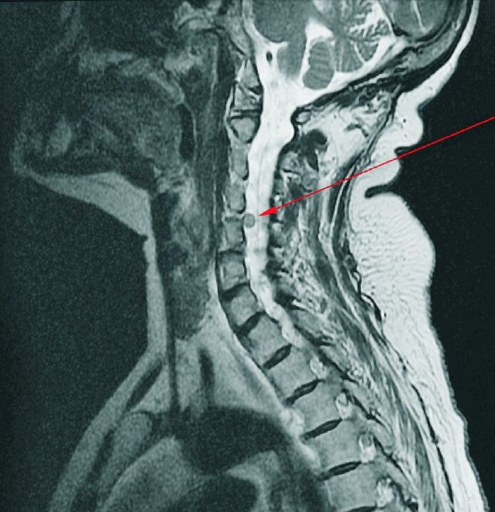 Ernia intervertebrale del rachide cervicale alla risonanza magnetica