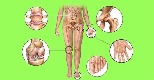articolazioni colpite da artrite e artrosi