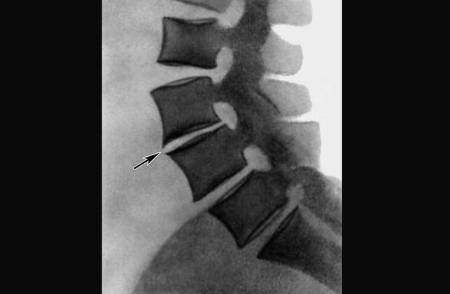 Manifestazioni di osteocondrosi della colonna vertebrale toracica sulla radiografia