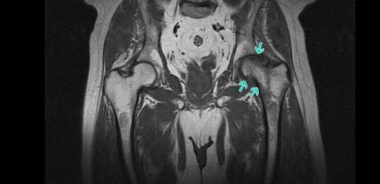 Alterazioni degenerative-distrofiche dell'articolazione dell'anca alla risonanza magnetica