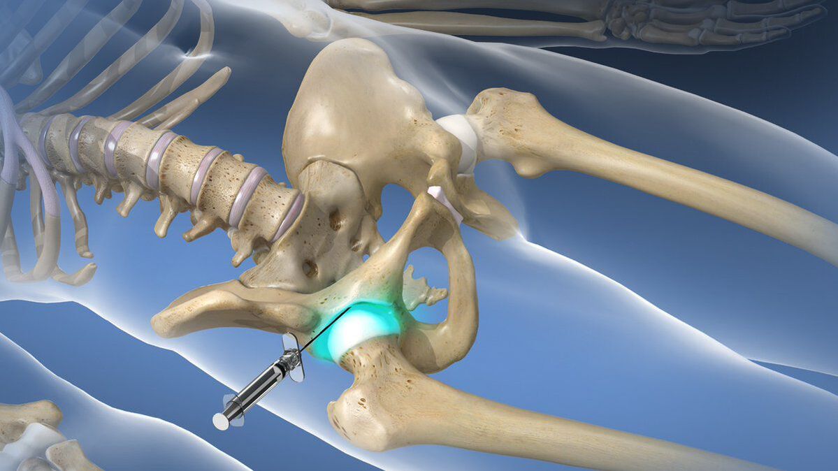 Blocco intra-articolare per eliminare il dolore acuto nella coxartrosi