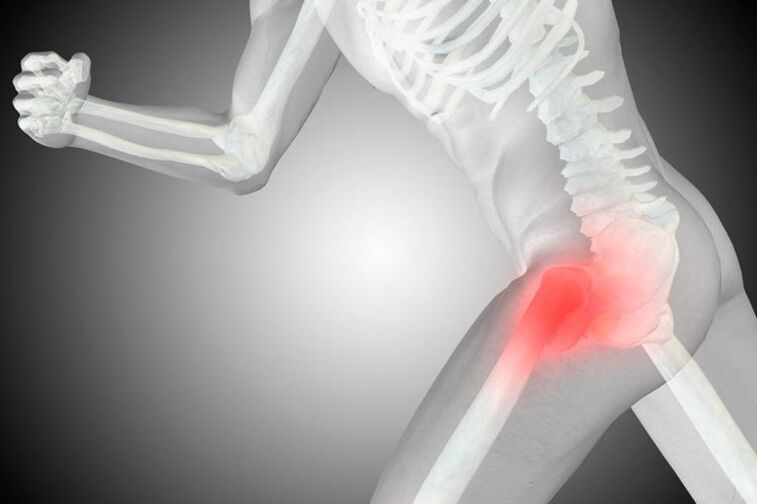 Coxartrosi dell'articolazione dell'anca