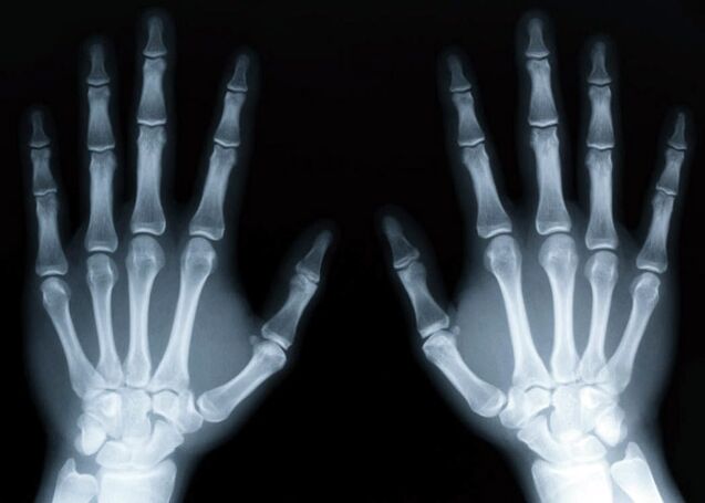 La gotta provoca lo sviluppo dell'artrite gottosa, che può essere diagnosticata utilizzando i raggi X